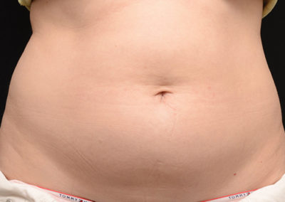 belly before treatment