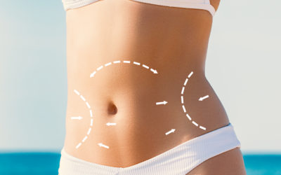 CoolSculpting vs Liposucción: ¿Cuál es el adecuado para ti?