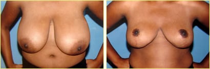 Fotos de resultados antes y después de la cirugía de reducción de senos