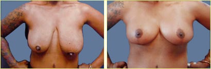 mastopexy 0123revb