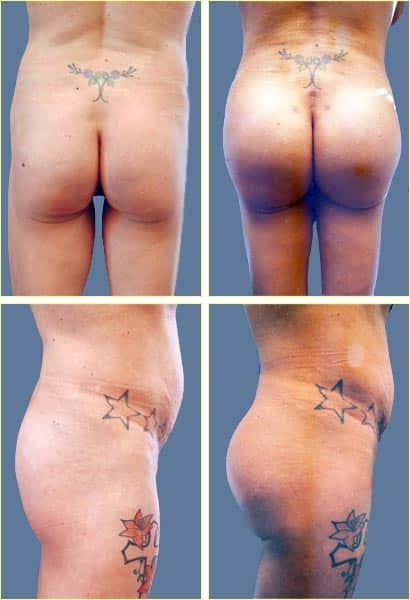 buttock01