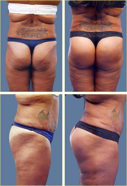 buttock02