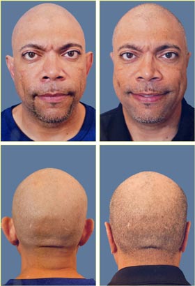 otoplasty31b