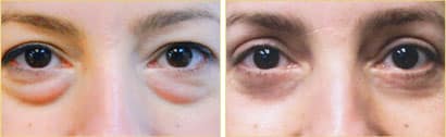 blefaroplastia1