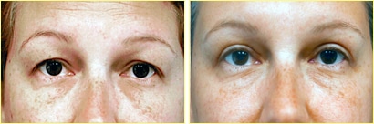 eyelid0728