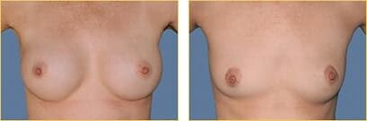 breast rev reversed